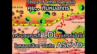 กลไกการเกิดโรคหลอดเลือดแข็งตัวเกิดขึ้นอย่างไรในร่างกาย