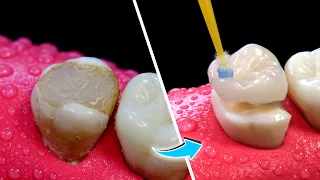 Proceso del cambio de restauración tipo Overlay