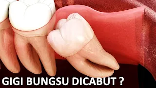 Download Gigi geraham bungsu harus dicabut atau tidak  MP3