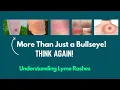 Lyme Disease Rash What Does It Really Look Like