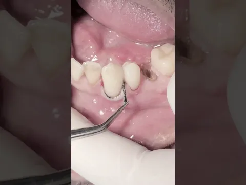 Lower left canine tooth 🦷 class V composite restoration #dentist