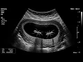 Fake Ultrasound Prank Fun