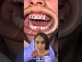 What happens at your brace fitting