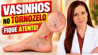 VAZINHOS NO TORNOZELO - Não Ignore este Sinal (Faça ISSO e Veja o que ACONTECE)