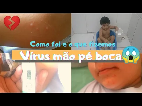 Download MP3 vírus mão pé boca/o que fiz pra ajudar aliviar os sintomas