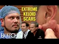 Trevor s Massive Keloid Scars Formed TWICE After Ear Piercings Before After Botched E