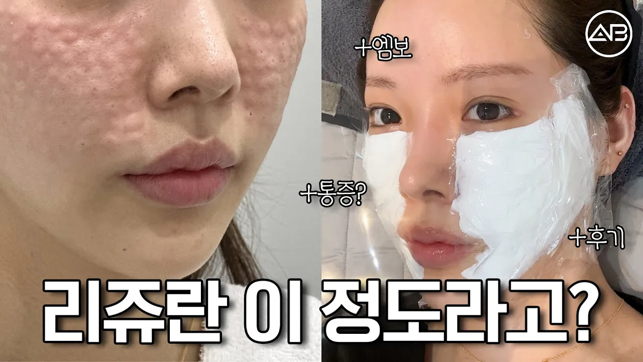 리쥬란은 화잘먹 시술이다?