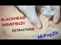 Gigantic Blackhead Minefield Imbedded stones in the back with multiple cysts Blackhead Extractions