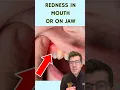 Download Lagu 7 signs of a dental abscess … #shorts