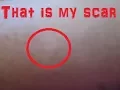 Storytime Dent In My Leg