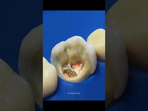 Root Canal Obturation