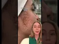 Laser Hair Removal Burn
