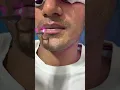 Download Lagu 🌟 Amazing Q-Switch Laser Treatment for Dark Lips! 💄✨ |  Skinaa Clinic  #viral #ytshorts #shortsfeed