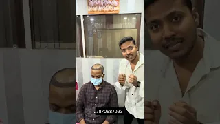 How much do 3,000 hair grafts cost in India? #hairtransplant