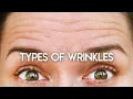 Types of Wrinkles