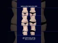 Lipo 360 Before and After in Dallas TX - Body Contouring by Dr John Burns