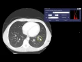 Window Width Window Level Concepts - CT Thorax Example
