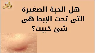 لدي حبة صغيرة تحت الإبط وليس لها رأس دهني وتؤلم فهل هى شئ خبيث   دندنها