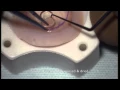 Download Lagu DMEK donor preparation - Simple technique