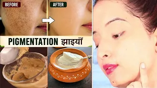 कितने भी मुश्किल झाइयाँ Pigmentation  काले धब्बे Spots हो, इस Remedy से होगा 100% इलाज