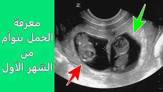 معرفة الحمل بتوأم من الشهر الأول وما هي علامات الحمل بتوأم من الشهر الأول 