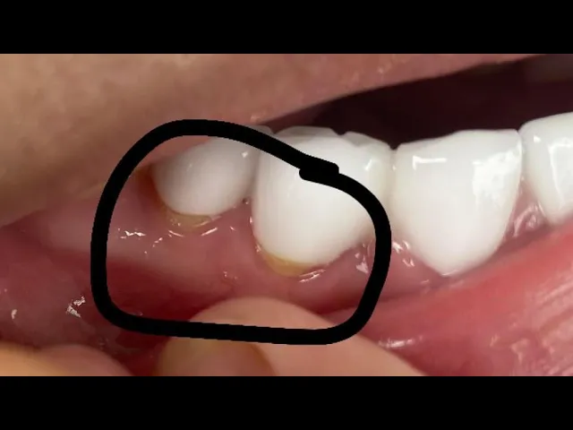 Outline Video Hở răng thật ngay dưới răng sứ: nguyên nhân tại sao? Hậu quả là gì?