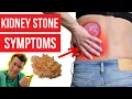 What symptoms do KIDNEY STONES cause Doctor explains PLUS how kidney stones are diagnosed more