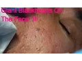 Giant Blackheads - Part III