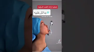 عمليه ازاله الغده الدرقيه 