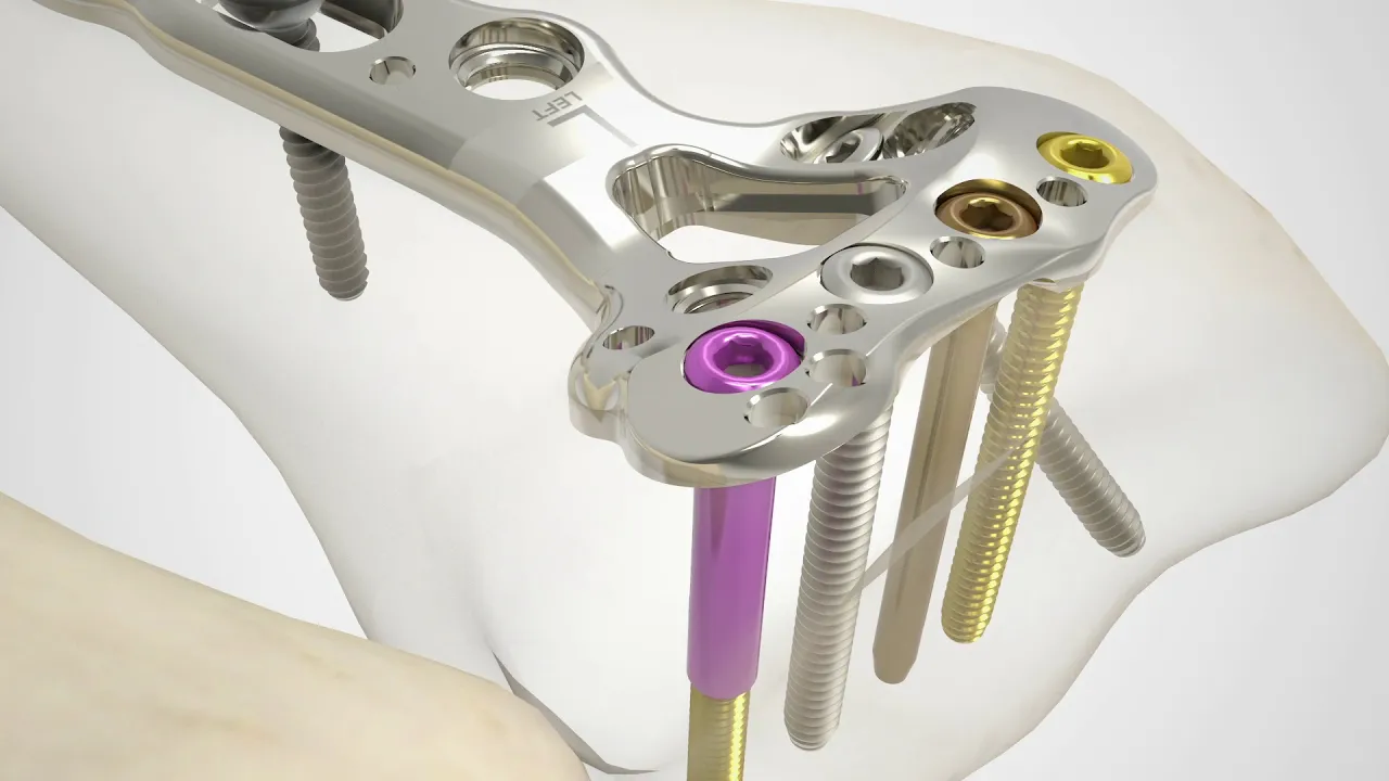 Acu-Loc 3D medical short video