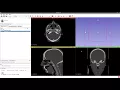 DICOM import on Slicer and export to OrtogOnBlender