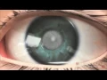 SPECTRALIS BluePeak Explanation Animation