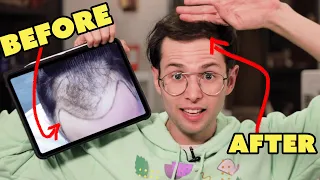 How I Fixed My Balding (One Year After Surgery)