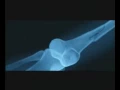 Video di Fragile - Trailer Italiano (2005)