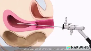عملية منظار الرحم                دندنها