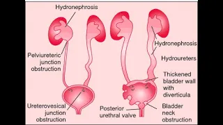 Hydroureter hydropelvis hydronephrosis pyonephrosis