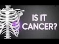Rib Pain Causes Cancer Risk When to Worry About Persistent Chest Wall Pain
