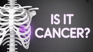 Rib Pain Causes Cancer Risk When to Worry About Persistent Chest Wall Pain