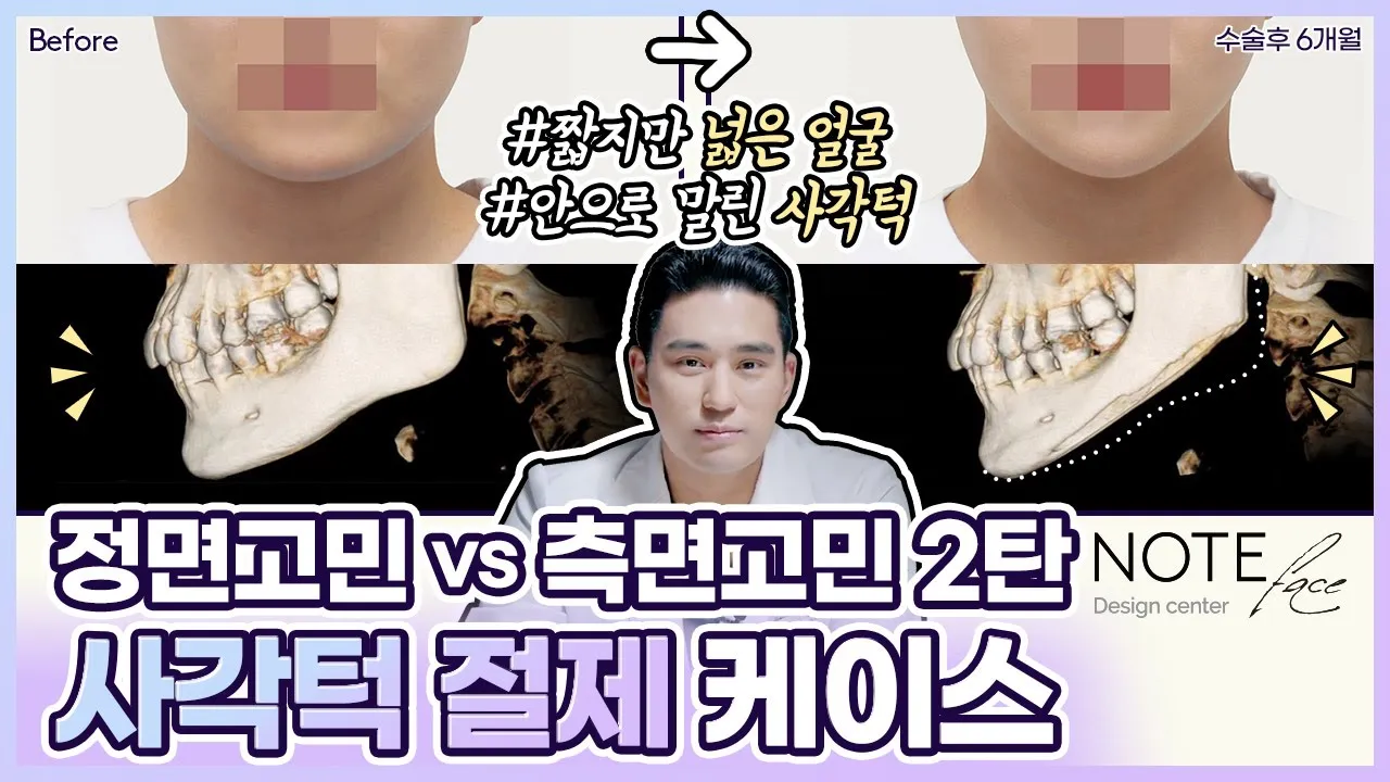 [유.케.리] 📍 CT로 보는 케이스 리뷰 l 사각턱 케이스 2탄 l 측면효과극대화 사각턱 축소 케이스