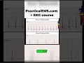 Download Lagu Sinus Tachycardia Explained: Fast Heart Rate Simplified