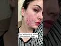 Download Lagu LUTA CONTRA ACNE NÃO É FÁCIL #shorts