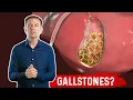 What is a Gallbladder Attack - Symptoms Causes Covered by Dr Berg