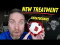 Best Keratoconus Treatment (New and Current!)