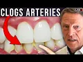 Download Lagu #1 Best Simple Way to Remove Dental Plaque (Avoid Clogged Arteries)