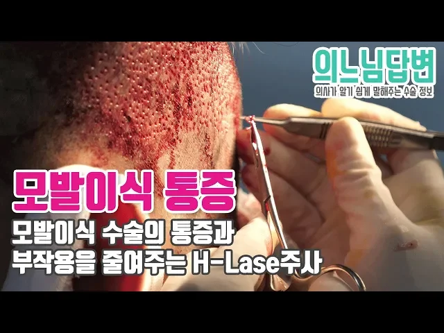 의느님답변📂ㅣ의느님답변 48회 모발이식 수술의 통증과 부작용을 줄여주는 H-Lase주사