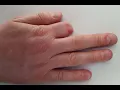 Amputation Transmetacarpal CPT code - simplify medical coding