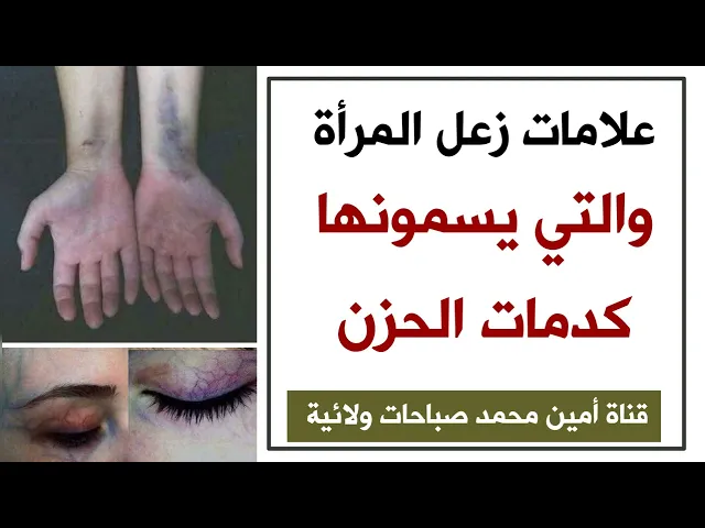 ⁣علامات زعل المرأة الشديد والتي يسمونها ( كدمات الحزن )