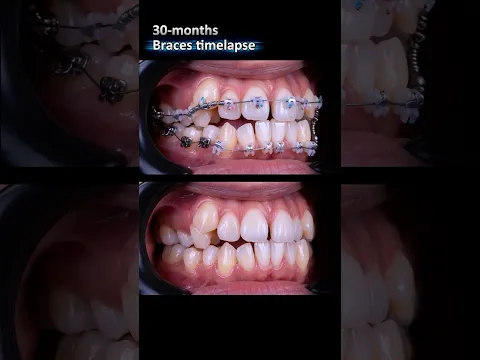Braces 30 months timelapse: From super crowded teeth to aligned #braces #orthodontist #orthodontics
