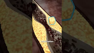 زیست شناسی حمله قلبی   دندنها