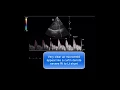 Amazing TCD bubble test to diagnose Rt to Lt shunt